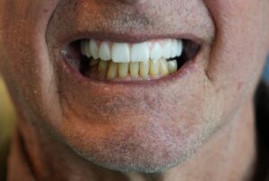 New Teeth Dental Implants